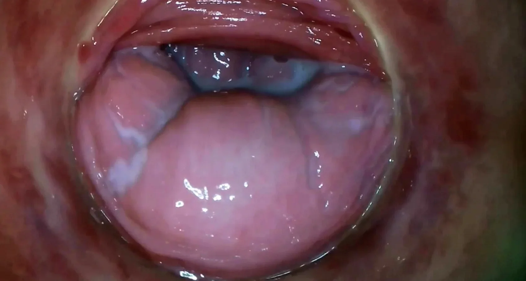 Cervix at the End of the Tunnel