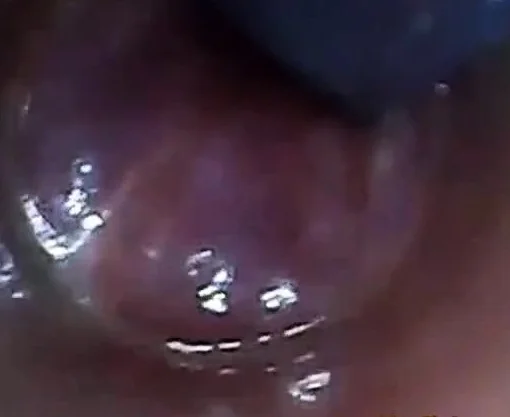 test tube cock endoscope POV urethral insertion ball rod