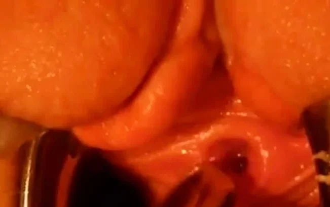 homemade catheter