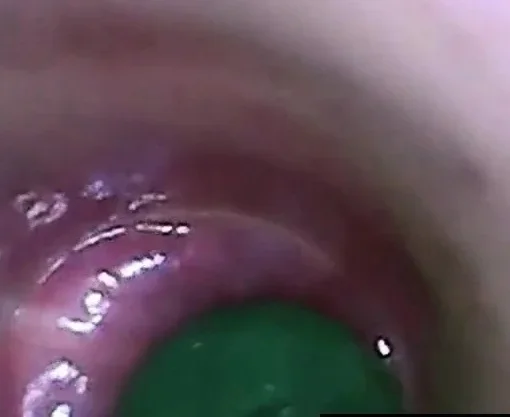 test tube cock endoscope POV urethral insertion ball rod