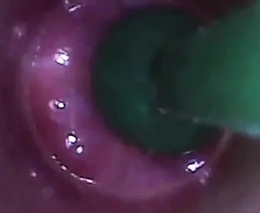 test tube cock endoscope POV urethral insertion ball rod